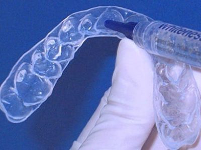 clareamento-dental-caseiro1