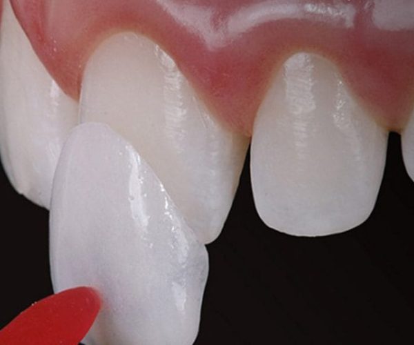 faceta-de-resina-ou-lente-de-contato-dental-diferença-qual-é-melhor-1038×576 faceta-de-resina-ou-lente-de-contato-dental-diferença-qual-é-melhor-1038x576