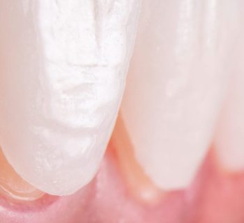 Try,In,Procedure,Of,Dental,Ceramic,Veneers,For,Lower,Teeth