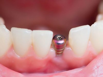 implante-pagina-interna-e1465696373166