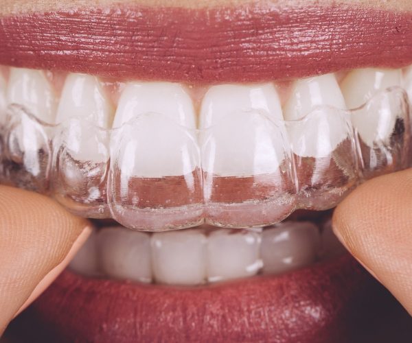 medicalys-invisalign-a-revolucao-digital-na-ortodontia-e-a-previsibilidade-do-tratamento-3c167430156c8e84a5117daaf42decf8 medicalys-invisalign-a-revolucao-digital-na-ortodontia-e-a-previsibilidade-do-tratamento-3c167430156c8e84a5117daaf42decf8