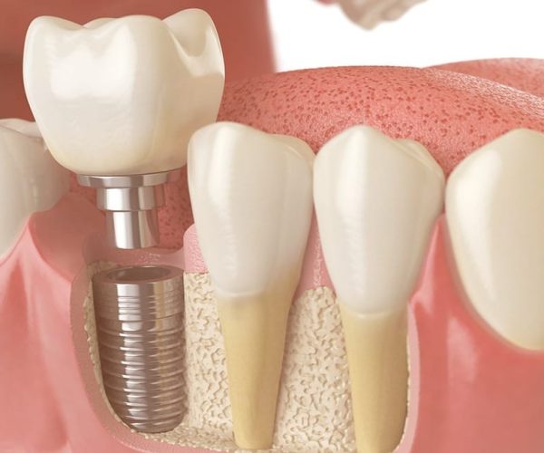 tipos-de-implantes-dentarios-1 tipos-de-implantes-dentarios-1